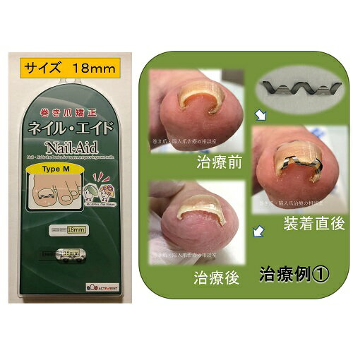 巻き爪治し方自分で巻き爪治療【ネイルエイド】まきづめ矯正リフト爪ブロックガードケア14mm