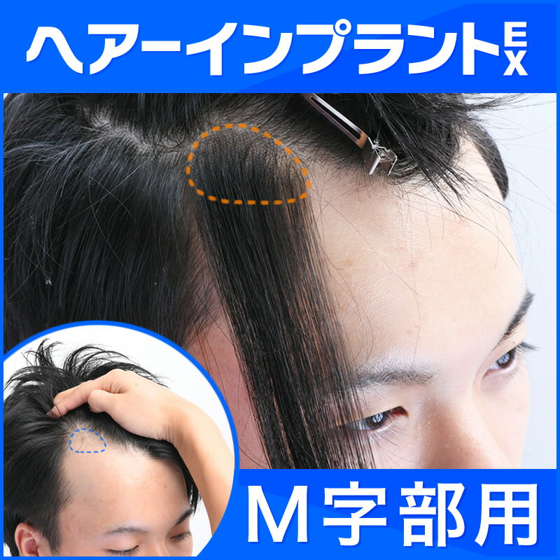 ヘアーインプラントEX M字部用(生え