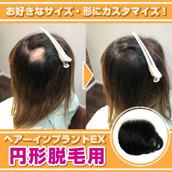 ヘアーインプラントEX円形脱毛症用