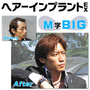 ヘアーインプラントEX M字用BIG(男性用かつら)※強力テープ貼り付け済み