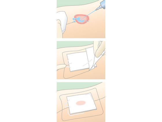 アルケア デルマエイド 1号 100枚入 11...の紹介画像3