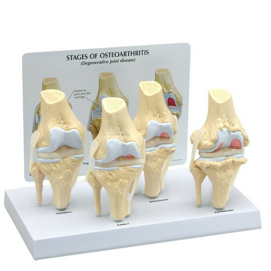 人体模型 変形性膝関節症/4段階 OM-GP-1100 日本語訳付き GPI Anatomicals