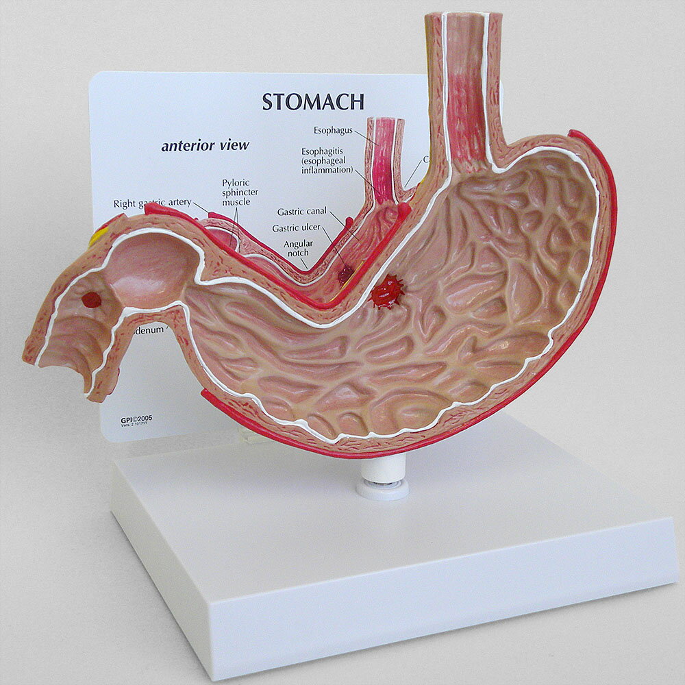 医学模型 胃と潰瘍 OM-GP-2000 日本語訳付き GPI Anatomicals