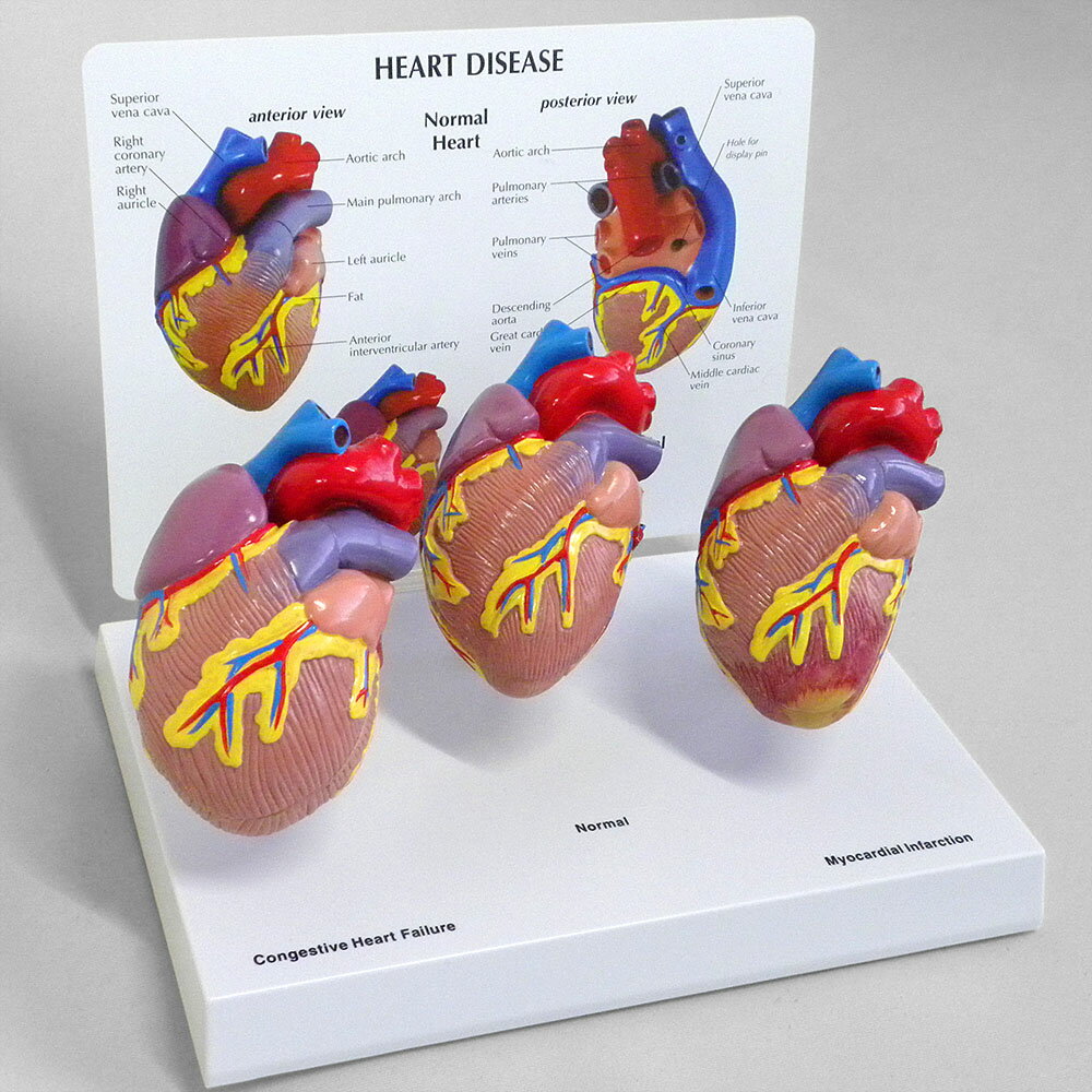 人体模型 心臓疾患 OM-GP-2550 日本語訳付き GPI Anatomicals