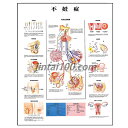 ポスター 不妊症 人体解剖図 医学ポスター 医学チャート 精液検査 精索静脈瘤 精子通過障害 潜伏精巣 停留睾丸 骨盤内炎症性疾患 頚管閉塞 排卵障害 卵管閉塞 子宮内膜症 避妊リングIUD 産婦人科