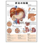 ポスター 肝炎の知識 医学ポスター 医学チャート 肝炎とは 肝炎の種類 肝炎の伝染経路 肝炎の進行 肝生検 肝炎の徴候と症状