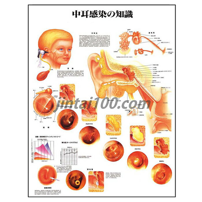 中耳感染の知識 人体解剖学ポスター J9892PL 中耳炎 鼓膜 人体解剖図 医学ポスター 医学チャート