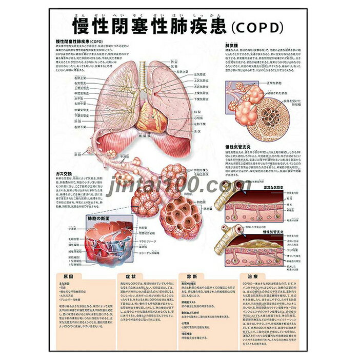 ポスター 慢性閉塞性肺疾患COPD 人体解剖図 医学ポスター 医学チャート 肺気腫 慢性気管支炎 肺胞 COPD原因 COPD症状 COPD診断 COPD治..