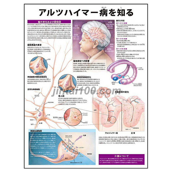 アルツハイマー病を知る ポスター J9976P 脳の老化 認知症 脳細胞構造 神経原線維 老人斑 大脳皮質変化 神経伝達物質 人体解剖図 医学ポスター 医学チャート