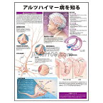 ポスター アルツハイマー病を知る 人体解剖図 医学ポスター 医学チャート 脳の老化 認知症 脳細胞構造の異常 神経原線維変化 老人斑 大脳皮質変化 神経伝達物質 アルツハイマー病の進行と対応 アルツハイマー病介護要点