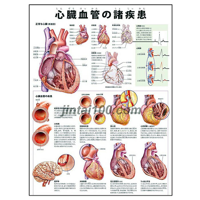 ポスター 心臓血管の諸疾患 人体解剖図 医学ポスター 医学チャート 患者啓蒙 結節性多発性動脈炎川崎病 冠動脈疾患 狭心症 心筋梗塞 脳卒中 大動脈瘤 左心室肥大 うっ血性心不全 心電図 心周期