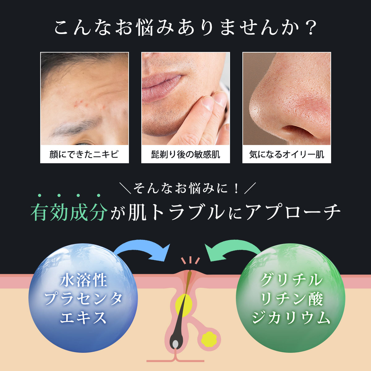 医薬部外品 MOREAGE 薬用 ニキビ パック メンズ パック 肌荒れ 対策 フェイス パック メンズ 30枚 シートマスク 日本製 顔 パック 大人 にきび 毛穴 パック アクネ ケア 吹き出物 スキンケア メンズコスメ 男性 ニキビケア メンズパック マスク