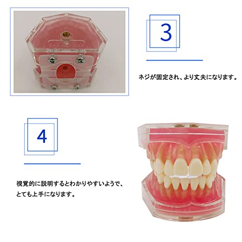 歯列模型 歯が抜く説明モデル 歯科インプラント 歯科模型 上下顎模型 研究治療説明用 取り外し可能 3