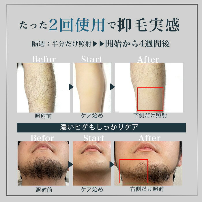 BELENUS ベレヌス 家庭用脱毛器 光美容器 女性用 男性用 男女兼用 家庭用 産毛 う...