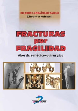 Fracturas por fragilidad