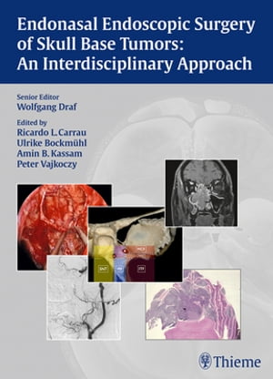 Endonasal Endoscopic Surgery of Skull Base Tumors: An Interdisciplinary Approach