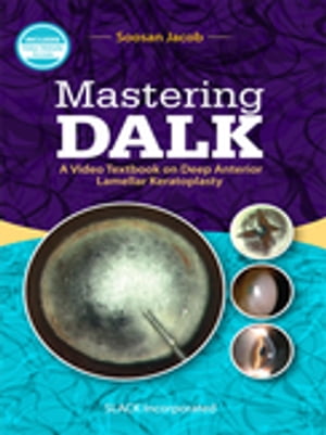 Mastering DALK A Video Textbook on Deep Anterior Lamellar Keratoplasty【電子書籍】