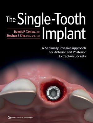 The Single-Tooth Implant: A Minimally Invasive Approach for Anterior and Posterior Extraction Sockets