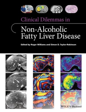 Clinical Dilemmas in Non-Alcoholic Fatty Liver Disease【電子書籍】[ Roger Williams ]