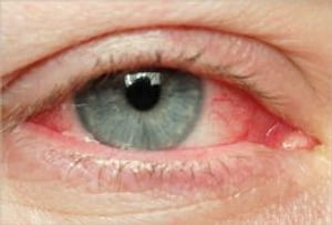 How To Get Rid of Bloodshot Eyes