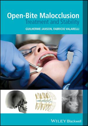 Open-Bite Malocclusion Treatment and Stability【電子書籍】
