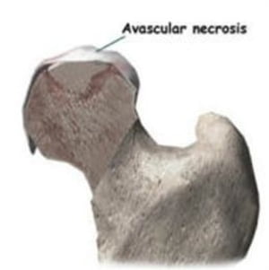 Avascular Necrosis: Causes, Symptoms and Treatments