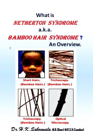 What is Netherton Syndrome a.k.a. Bamboo Hair Syndrome ? An Overview.