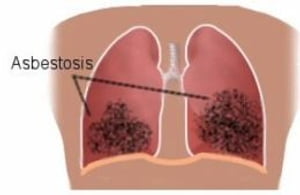 Asbestosis: Causes, Symptoms and Treatments