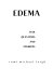 Edema