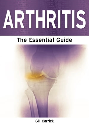 Arthritis: The Essential Guide