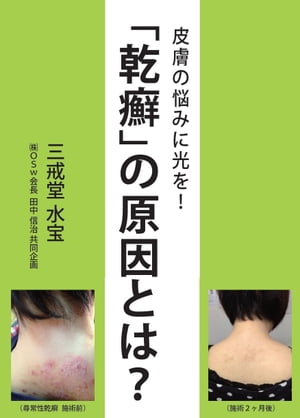 皮膚の悩みに光を！　「乾癬」の原因とは？【HOPPAライブラリー】