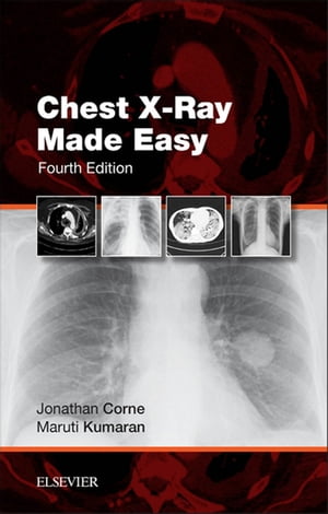 Chest X-Ray Made Easy E-Book