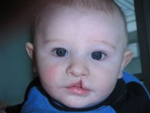 Cleft Lip and Cleft Palate: Causes, Symptoms and Treatments