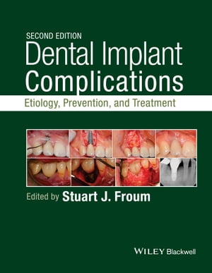Dental Implant Complications Etiology, Prevention, and Treatment
