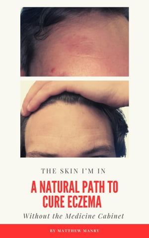 The Skin I'm In: A Natural Path to Cure Eczema