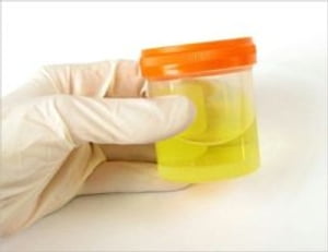 An Informative Guide About Proteinuria (Protein in Urine): Symptoms, Causes, Treatments and more