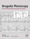Brugada Phenocopy The Art of Recognizing the Brugada ECG Pattern