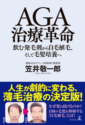 AGA治療革命　飲む発毛剤から自毛植毛、そして毛髪培養へ