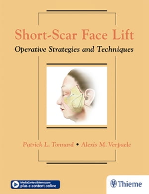 Short-Scar Face Lift