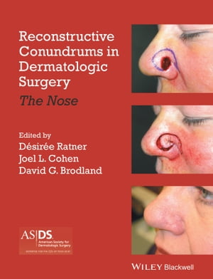 Reconstructive Conundrums in Dermatologic Surgery The Nose