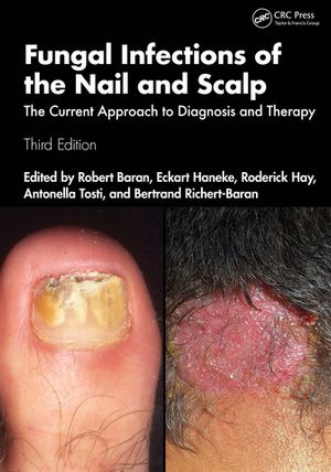 Fungal Infections of the Nail and Scalp The Current Approach to Diagnosis and Therapy【電子書籍】