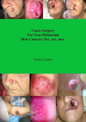 Cases Surgery For Non-Melanoma Skin Cancers: bcc, scc, mcc.