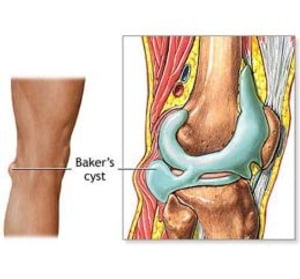 Baker's Cyst: Causes, Symptoms and Treatments