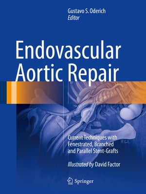 Endovascular Aortic Repair Current Techniques with Fenestrated, Branched and Parallel Stent-Grafts