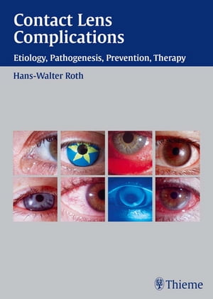 Contact Lens Complications Etiology, Pathogenesis, Prevention, Therapy