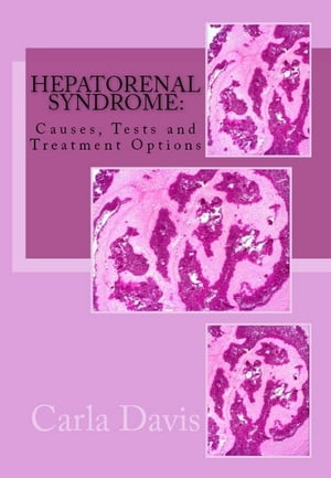 Hepatorenal Syndrome: Causes, Tests, and Treatment Options