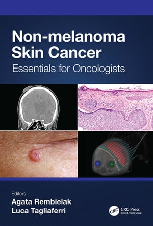 Non-melanoma Skin Cancer Essentials for Oncologists