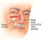 Nasal Polyps: Causes, Symptoms and Treatments