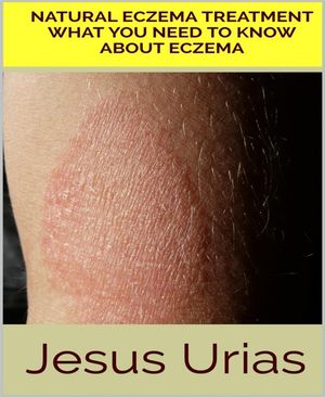 Natural Eczema Treatment