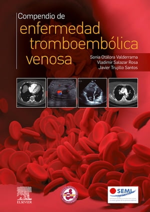 Compendio de enfermedad tromboembólica venosa